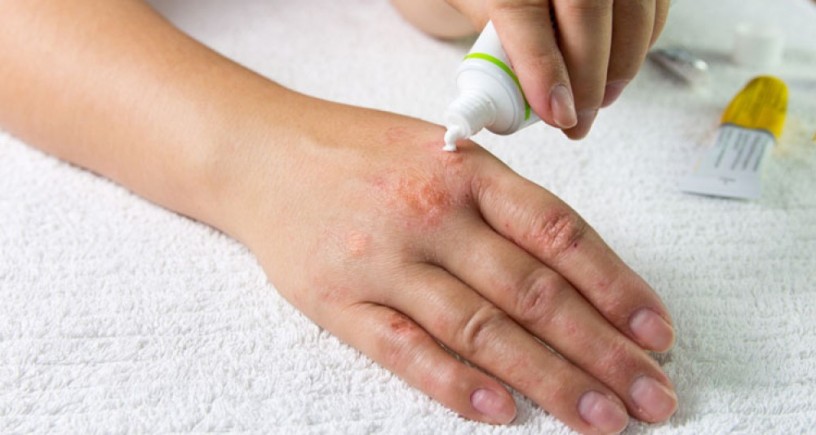 Pharma Franchise Company for Antifungal Cream 1