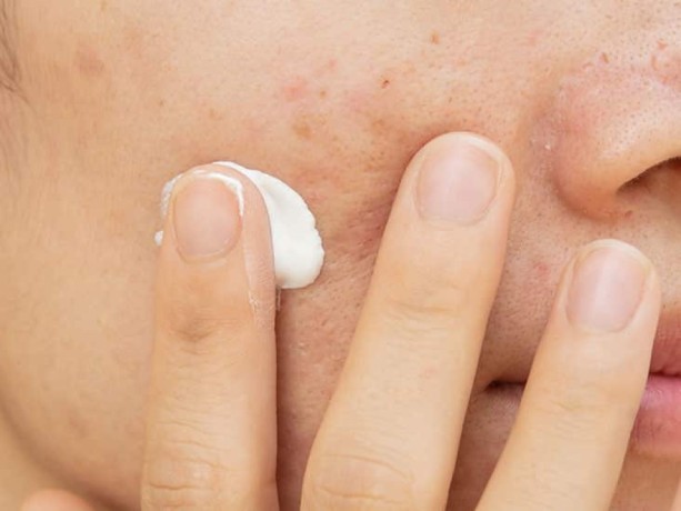 Pharma Franchise for Antifungal Cream 1